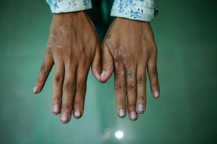 A person's hands showing scars